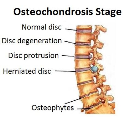 Osteokondrosiaren faseak
